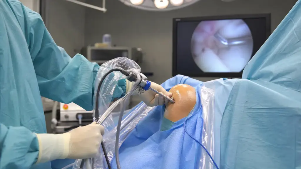 15 Arthroscopic Shoulder Stabilisation 1